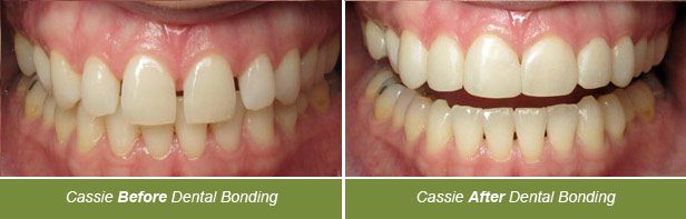Dental Bonding, Dentistry on Vine, Hudson WI
