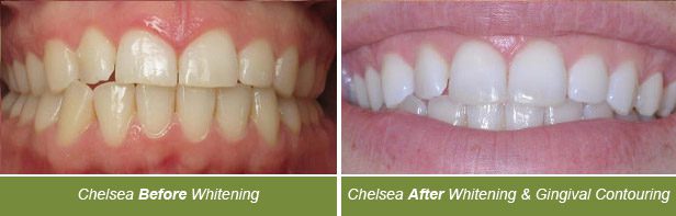 Dental Whitening, Dentistry on Vine, Hudson WI