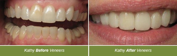 Veneers, Dentistry on Vine, Hudson WI