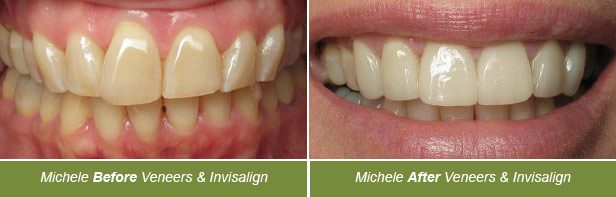 Dental Before and After, Dentistry on Vine, Hudson WI