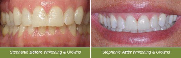 Dental Crowns, Dentistry on Vine, Hudson WI