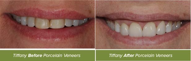 Dental Crowns, Dentistry on Vine, Hudson WI