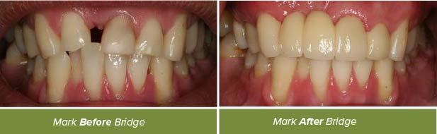 Dental Crowns, Dentistry on Vine, Hudson WI