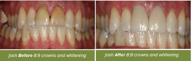 Dental Crowns, Dentistry on Vine, Hudson WI
