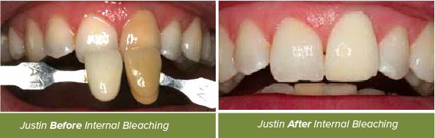 Dental Crowns, Dentistry on Vine, Hudson WI