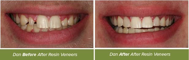 Dental Crowns, Dentistry on Vine, Hudson WI